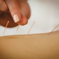 6 tévhit az akupunktúráról