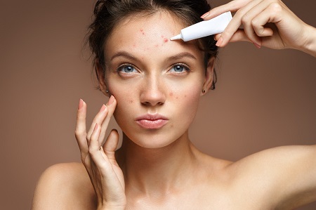 Pattanásos arcbőr - nem csak a higiénia hiánya okozhatja
