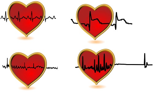 Egyes szívdobbanások előrevetíthetik a szívritmuszavart