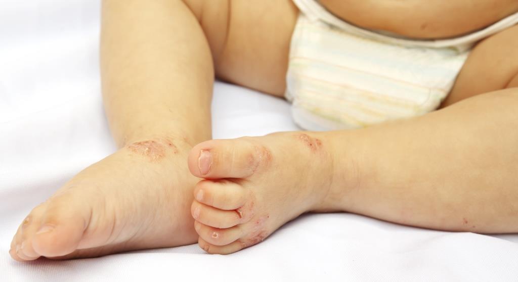 Hogyan kezeld kisbabád kipirosodott, száraz bőrét?