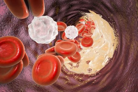 Nem csak az életmód a felelős, örökölhető is a magas koleszterinszint