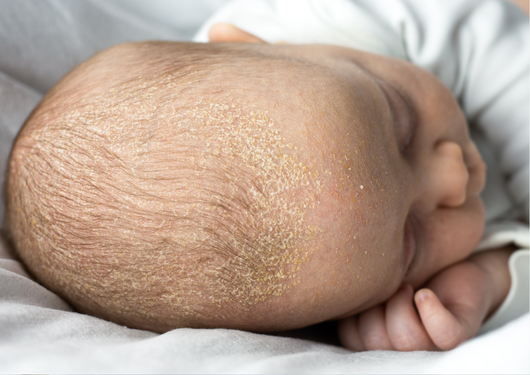 Sárga, pikkelyes felrakódás a fejbőrön? A koszmónak semmi köze a koszhoz