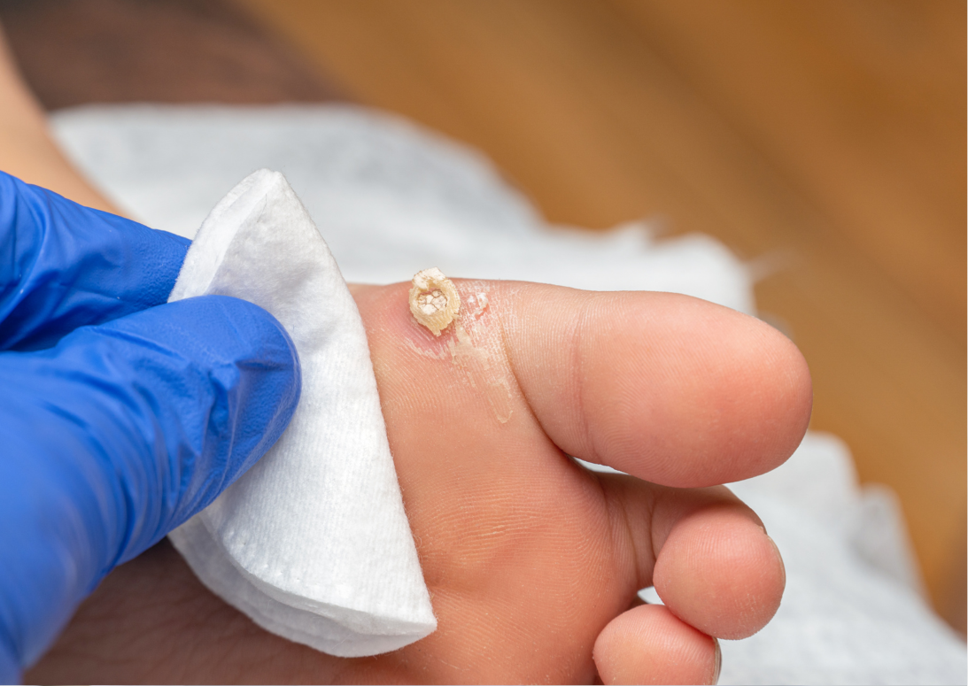 Makacs szemölcs a gyermek talpán? Bízzuk a bőrgyógyászra!