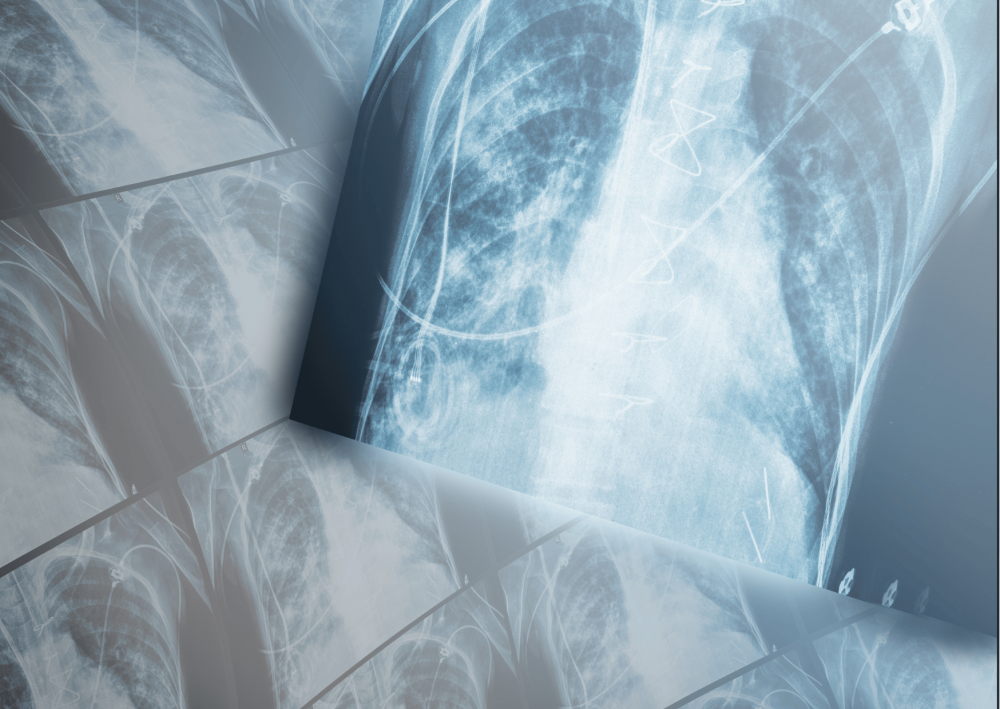 A COPD a tüdő visszafordíthatatlan károsodásával jár.