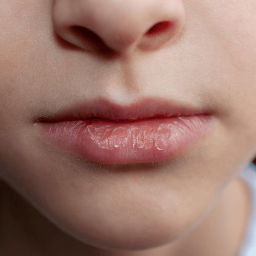 Orvosi fémek is okozhatnak fogászati allergiát