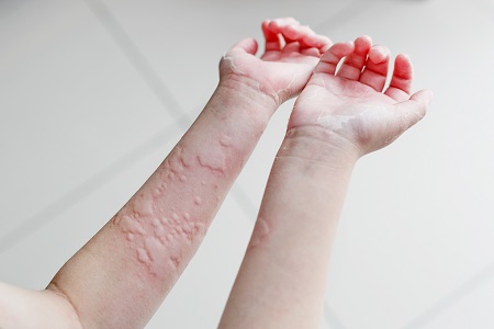 A krónikus csalánkiütést bőrgyógyásznak kell kezelnie.