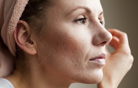 A bőrgyógyászati kezelés sokat segít a rozácea állapotán.