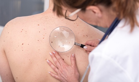 Több nő jár bőrgyógyászati szűrésre - kutatás a Melanoma Világnapja alkalmából 