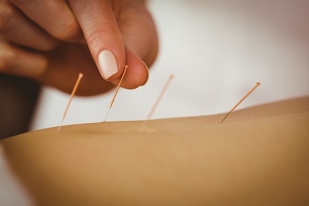 Hogyan hat az akupunktúrás fájdalomcsillapítás?