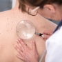 UV-sugárzás, legyengült immunrendszer? Tegyünk a melanoma rizikófaktorai ellen