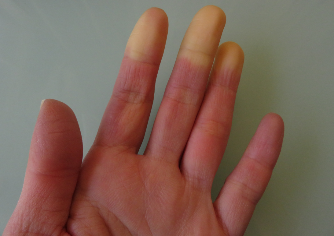 Amikor a diagnózis: szkleroderma