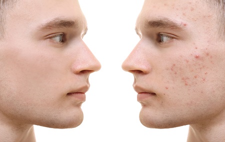 Pattanásos arcbőr esetén fontos a bőrgyógyászati kezelés.